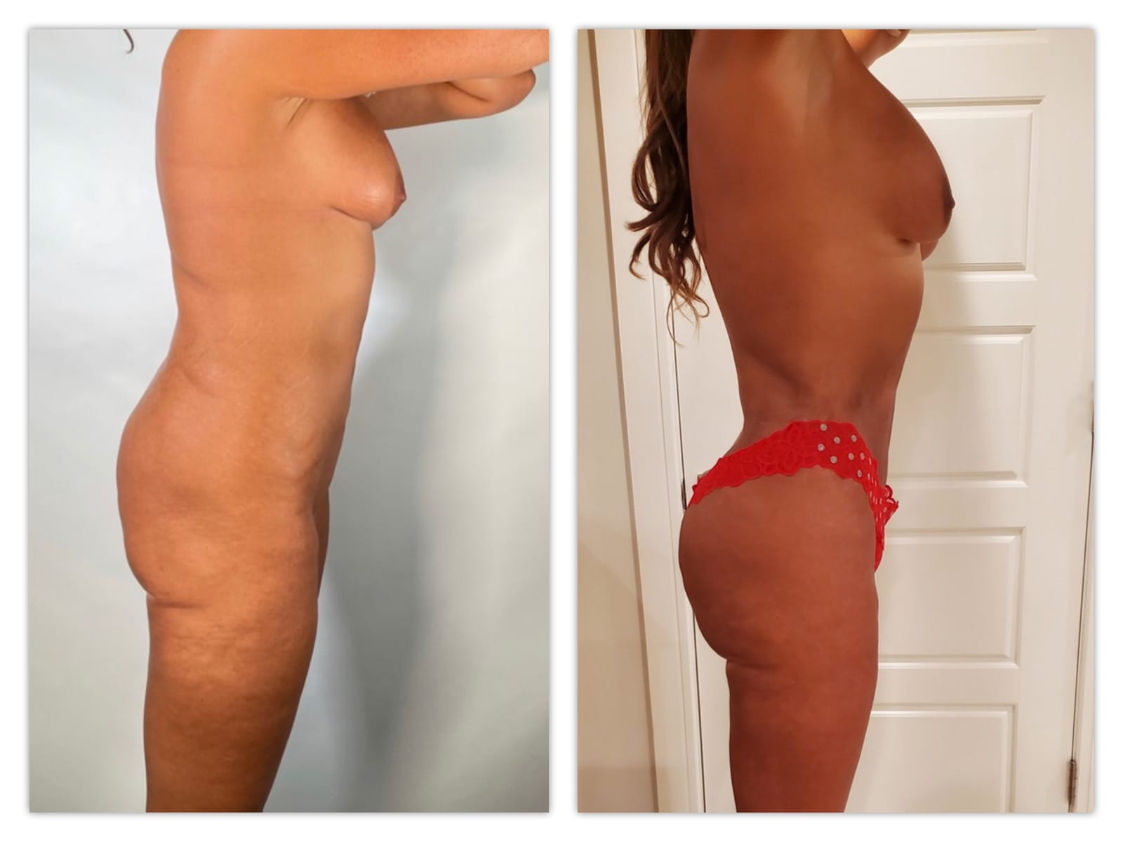 Brazilian Butt Lift Before & After Gallery - Patient 133183722 - Image 3