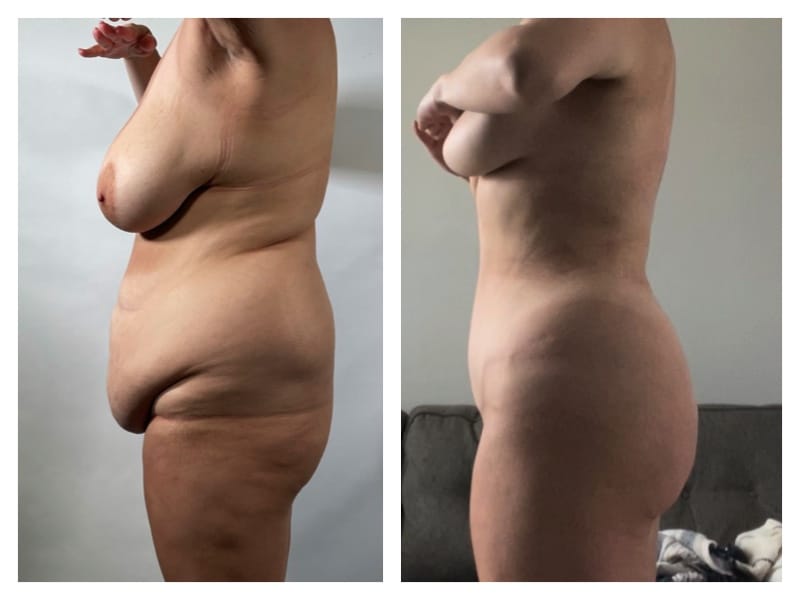 Tummy Tuck Before & After Gallery - Patient 133183890 - Image 3