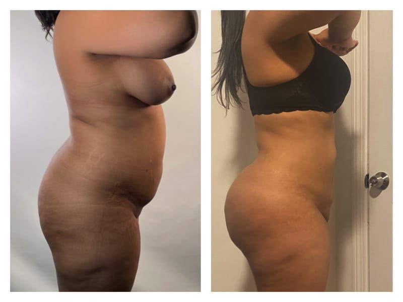 Liposuction Before & After Gallery - Patient 133183914 - Image 4