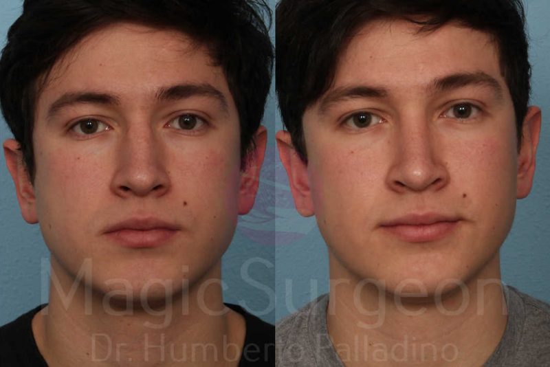 Rhinoplasty Before & After Gallery - Patient 133182411 - Image 1