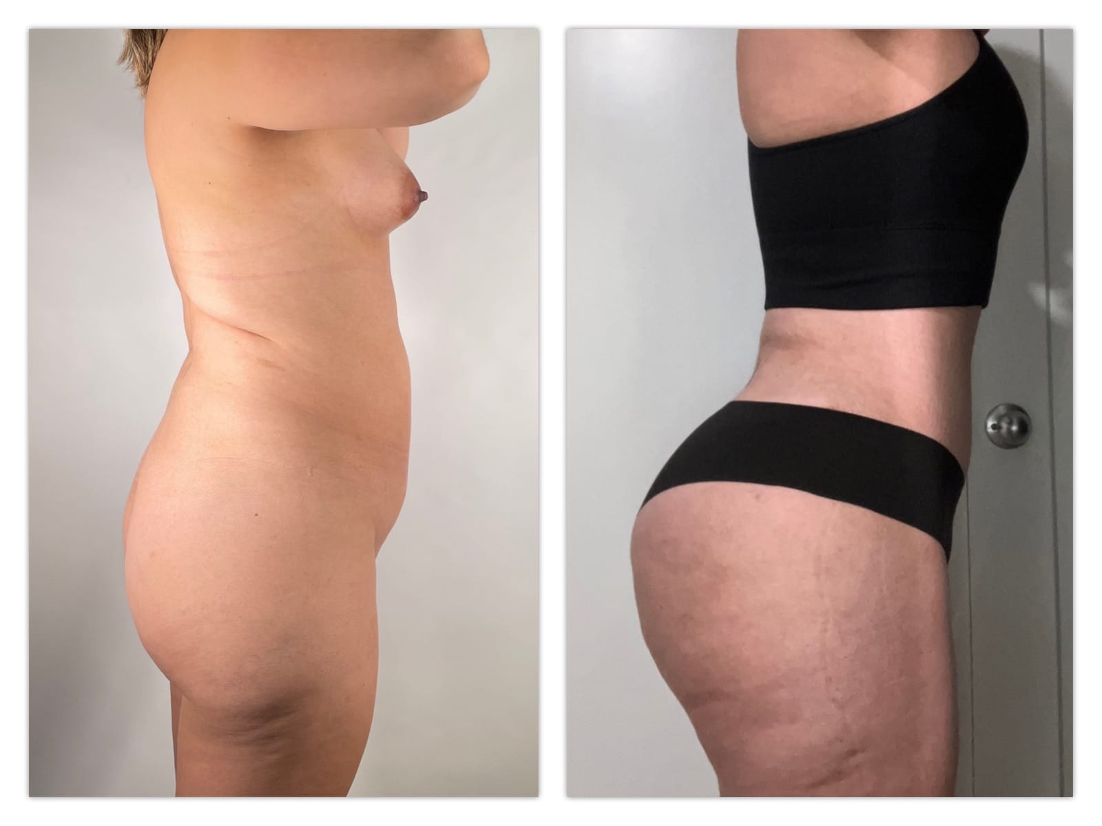 Brazilian Butt Lift Before & After Gallery - Patient 133183874 - Image 2