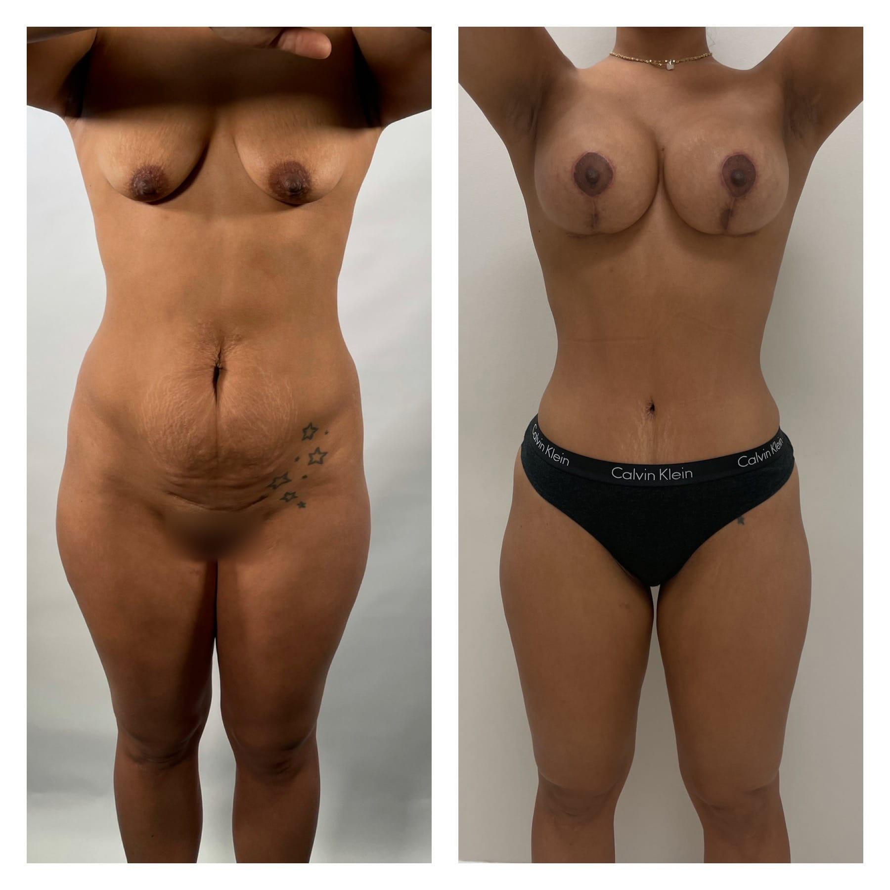 Mommy Makeover Before & After Gallery - Patient 133183823 - Image 1