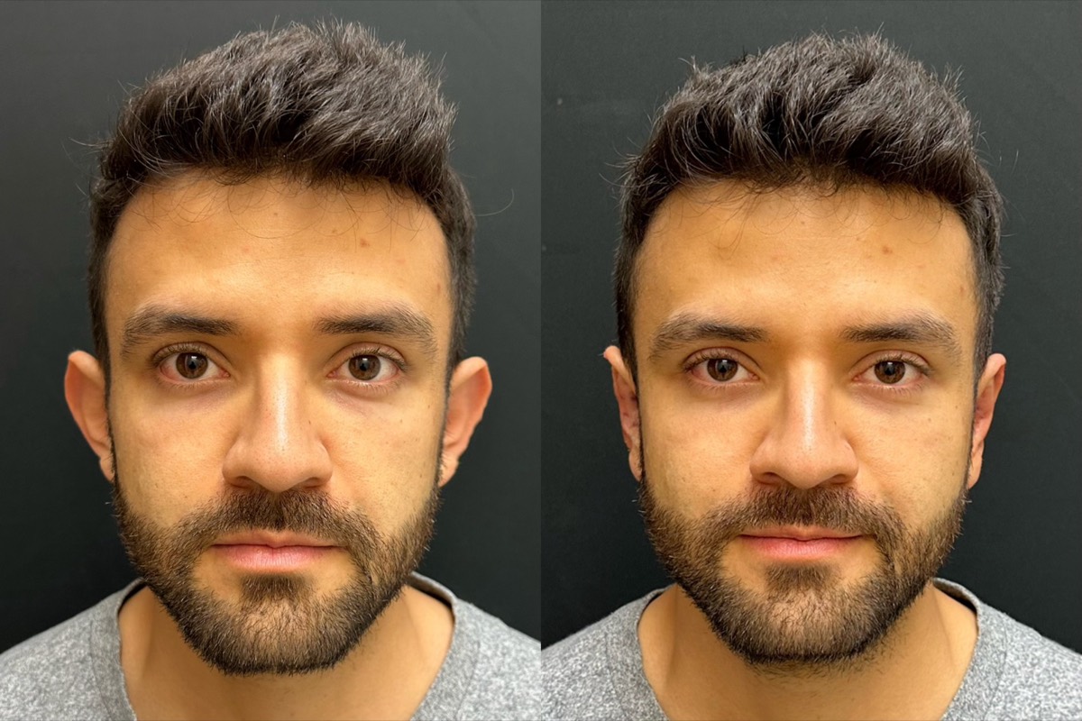 InstaEarFix ear correction before and after &mdash; patient age 24
