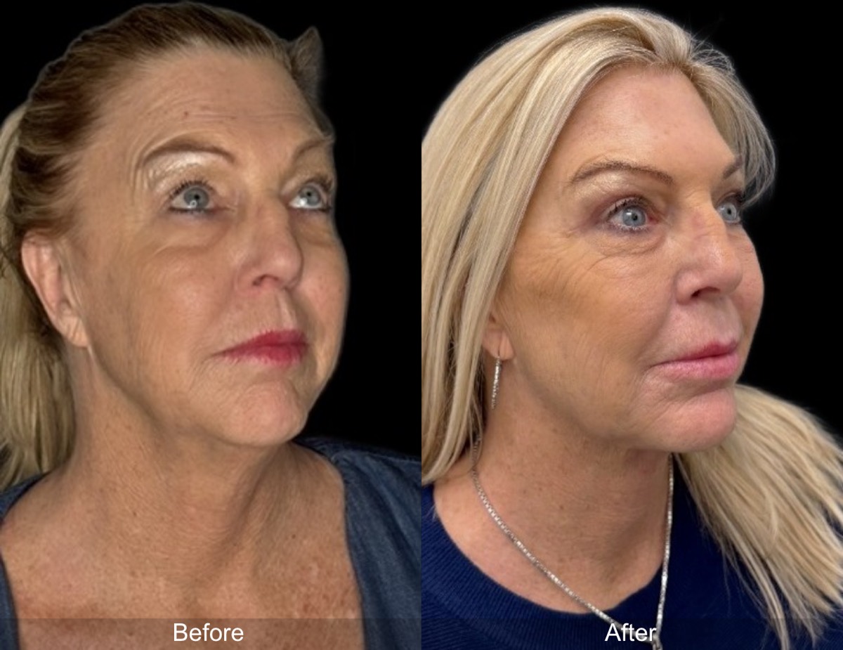 InstaFix Face and Neck before and after &mdash; 59-year-old patient, view 1