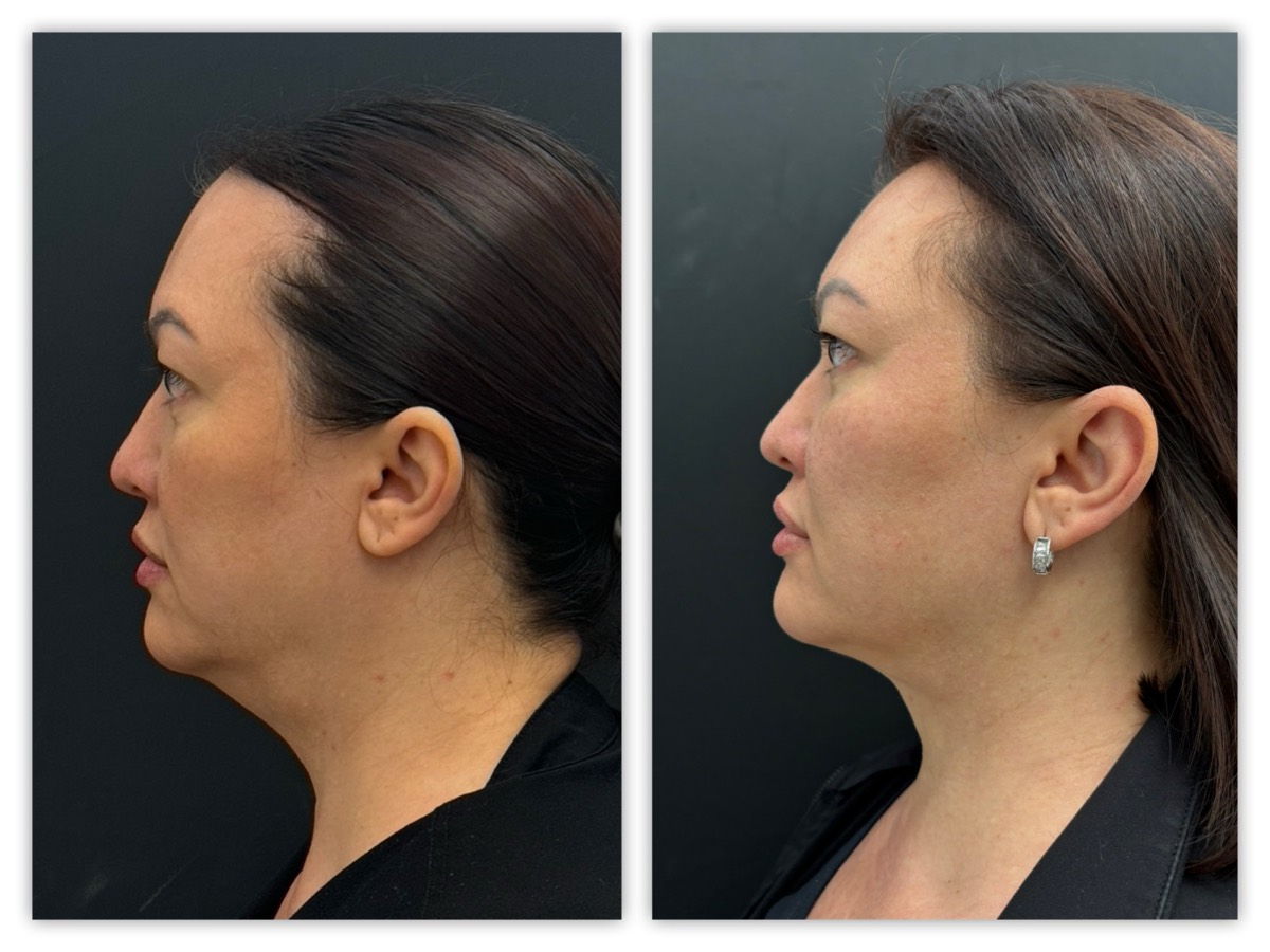 InstaFix Neck contouring before and after &mdash; 45-year-old patient, profile view 1