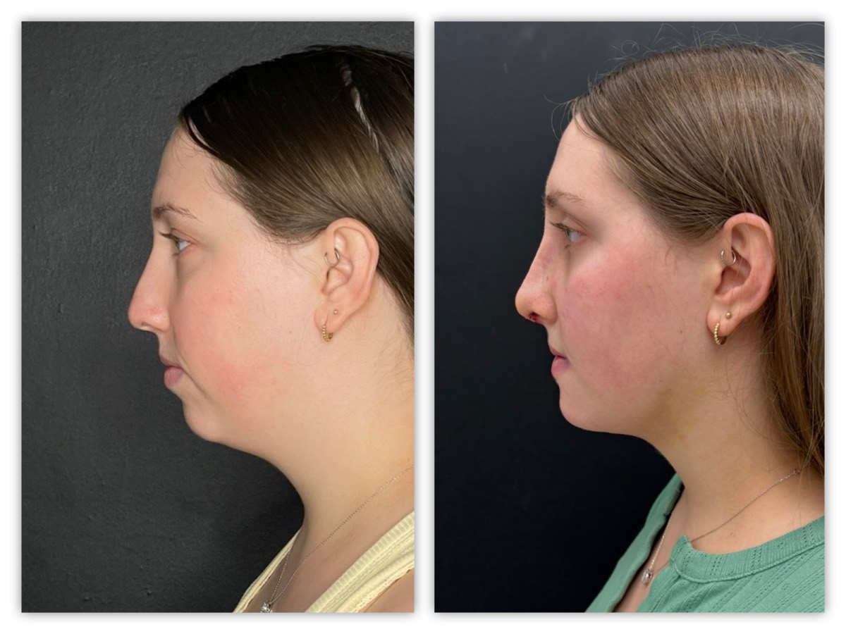 InstaFix neck and profile refinement before and after &mdash; young patient, view 1