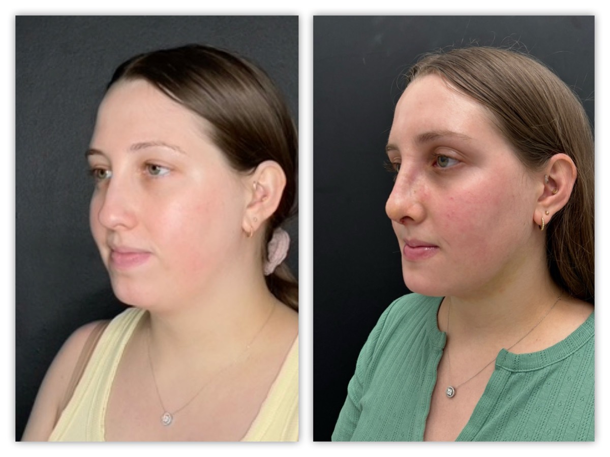InstaFix neck and profile refinement before and after &mdash; young patient, view 2